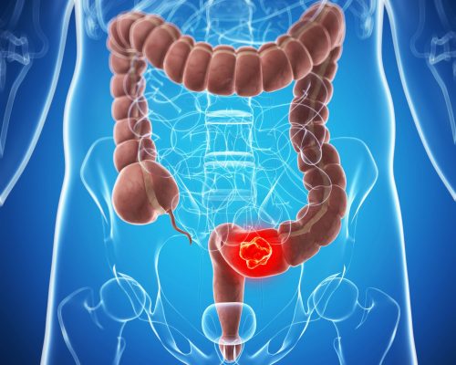 colorectal cancer