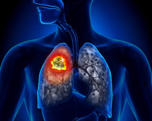 lung cancer